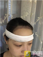 太原显微植发王亚丽医生种植发际线好不好?相关案例_2021相关价目表