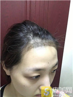 太原显微植发王亚丽医生种植发际线好不好?相关案例_2021相关价目表