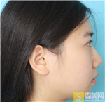 宁波韩美美容医院硅胶垫下巴怎么样?硅胶垫下巴案例果_2021项目价目表