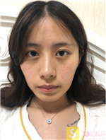 海南曙光梦妮幻整形美容做自体脂肪填充全脸怎么样？2020价格表曝光+填充真人案例分享