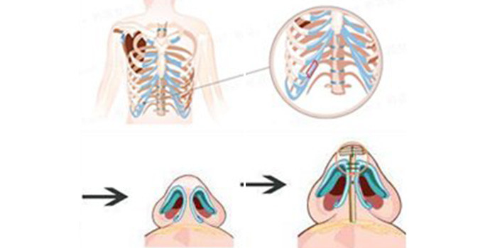 假体隆鼻优点那么多,为什么还是那么多人选择