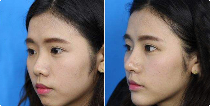 假体隆鼻优点那么多,为什么还是那么多人选择