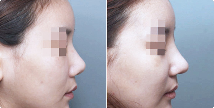 假体隆鼻优点那么多,为什么还是那么多人选择