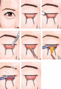 外切法去眼袋的介绍、价格、优缺点和注意事项是什么？