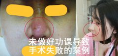 隆鼻术前术后不做好这几件事，极容易导致手术