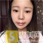 重庆奥妃整形的M唇手术案例,2021唇部手术价格表分享