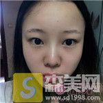 重庆奥妃整形的M唇手术案例,2021唇部手术价格表分享