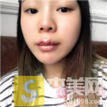 重庆奥妃整形的M唇手术案例,2021唇部手术价格表分享