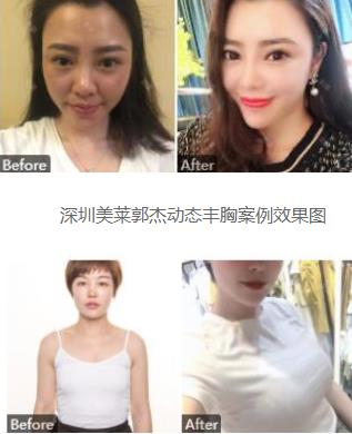 深圳美莱郭杰医生的相关案例和介绍