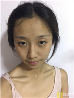 北京佰嘉利费书宇自体脂肪全脸填充好不好?相关案例展示+2021填充价目表