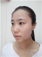 天津奥薇和谐丛相文做自体脂肪全脸填充果?附相关案例展示+2021项目价目表