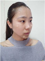 天津奥薇和谐丛相文做自体脂肪全脸填充果?附相关案例展示+2021项目价目表