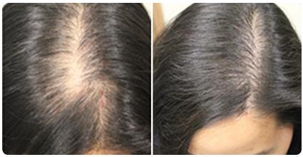 浙江壹加壹付晓医生的植发多少钱?案例和概况