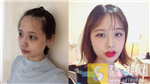 深圳大学第一附属医院整形美容科面部填充全脸怎么样？附填充案例及2020价格表公开