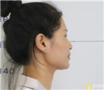 成都华美紫馨白振华医生做脂肪填充如何？附填充案例及价格表曝光