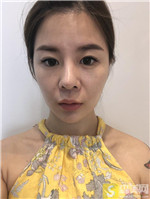 北京禾美嘉任学会做自体脂肪填充怎么样?加一个案例分享及2021项目价格表