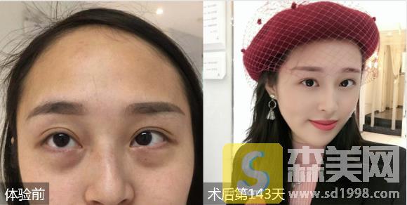 暨南大学附属第一医院整形科怎么样？医生简介+价格表一览+祛眼袋案例