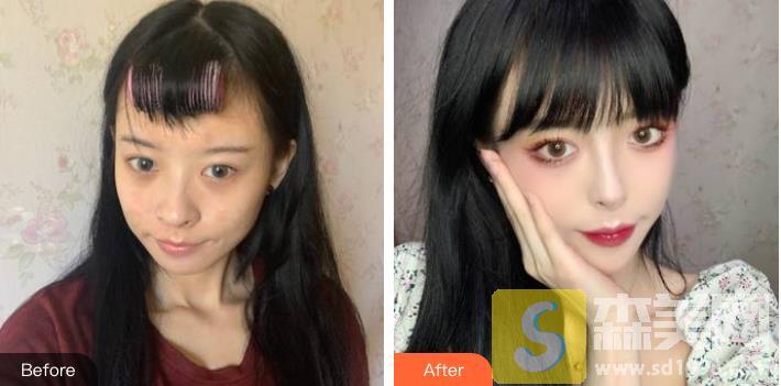 暨南大学附属第一医院整形科怎么样？医生简介+价格表一览+祛眼袋案例