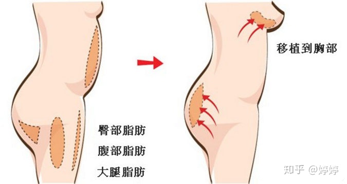 整形必看|做自体脂肪隆胸需要什么条件？