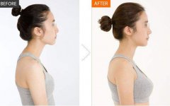 整形必看|做自体脂肪隆胸需要什么条件？