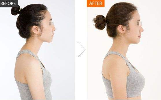 整形必看|做自体脂肪隆胸需要什么条件？