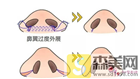 解读鼻尖缩小整形手术，术后注意事项大全~