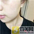 淡化斑痕小妙招：如何去除脸上黄褐斑？4种方案真不错