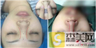 怎样垫高鼻梁