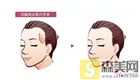 自体脂肪丰下巴会全部吸收了吗？