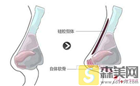 【术前科普】硅胶垫鼻梁多久要取出来？