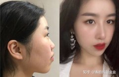 成都隆鼻哪里好?成都隆鼻较全攻略来了!速码!!