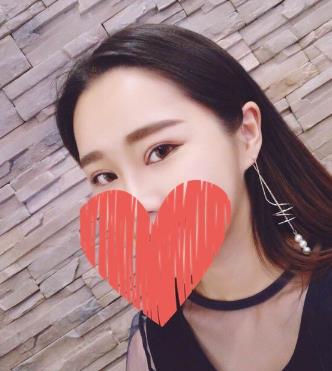 苏州省立医院整形科刘武林双眼皮好不好？真实术后照片分享
