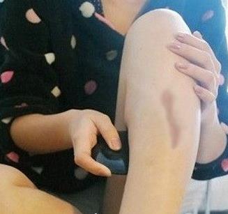 河北医科大学医院美容整形科去疤痕怎么样？要多少钱？真实案例分享