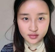 深圳非凡整形医院磨骨技术好不好?磨骨手术恢复过程