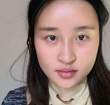 深圳非凡整形医院磨骨技术好不好？磨骨手术恢复过程