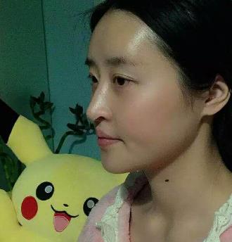 深圳非凡整形医院磨骨技术好不好？磨骨手术恢复过程