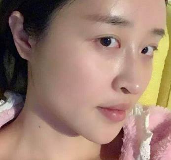 深圳非凡整形医院磨骨技术好不好？磨骨手术恢复过程