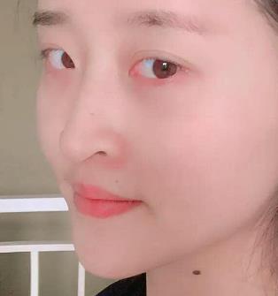 深圳非凡整形医院磨骨技术好不好？磨骨手术恢复过程