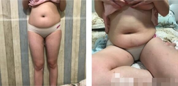 河南省人民医院整形美容中心吸脂怎么样？吸脂减肥恢复过程揭秘