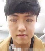 北京八大处整形医院磨骨瘦脸怎么样？术后恢复过程分享