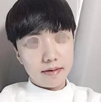 北京八大处整形医院磨骨瘦脸怎么样？术后恢复过程分享