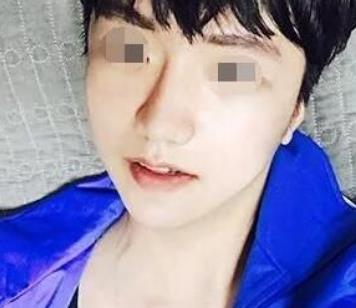 北京八大处整形医院磨骨瘦脸怎么样？术后恢复过程分享