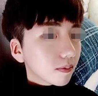 北京八大处整形医院磨骨瘦脸怎么样？术后恢复过程分享