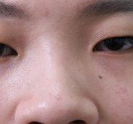 江苏省中医院整形外科双眼皮手术怎么样？真实案例分享