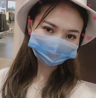江苏省中医院整形外科双眼皮手术怎么样？真实案例分享