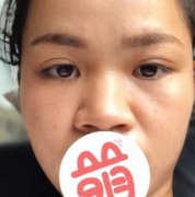 福建省立医院整形外科假体隆鼻果好不好？附术后恢复过程