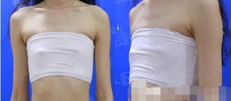 蚌埠美莱坞整形医院隆胸怎么样？真实假体隆胸恢复过程