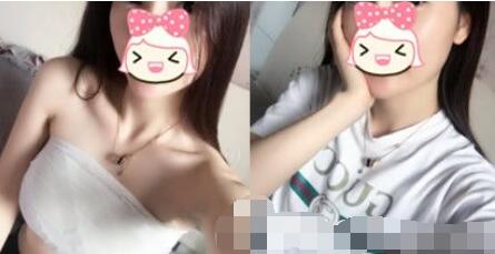蚌埠美莱坞整形医院隆胸怎么样？真实假体隆胸恢复过程