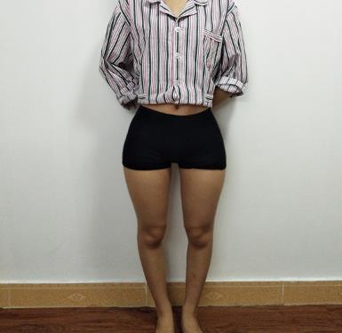 重庆军美武剑大腿吸脂怎么样?术后个月经验分享,大腿真的细了