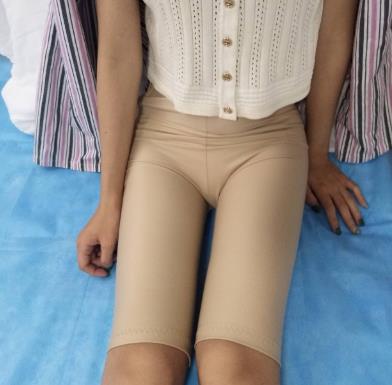 重庆军美武剑大腿吸脂怎么样?术后个月经验分享,大腿真的细了